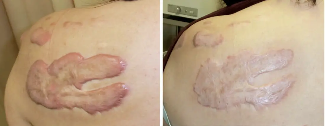 Before and after images of a raised shoulder keloid plaque that becomes flat and pale after treatment.