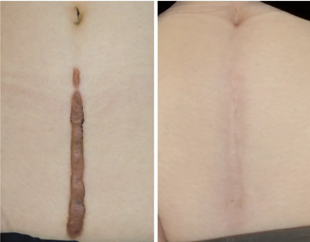 Before and after photos of a long midline abdominal keloid scar that smooths and fades with treatment.