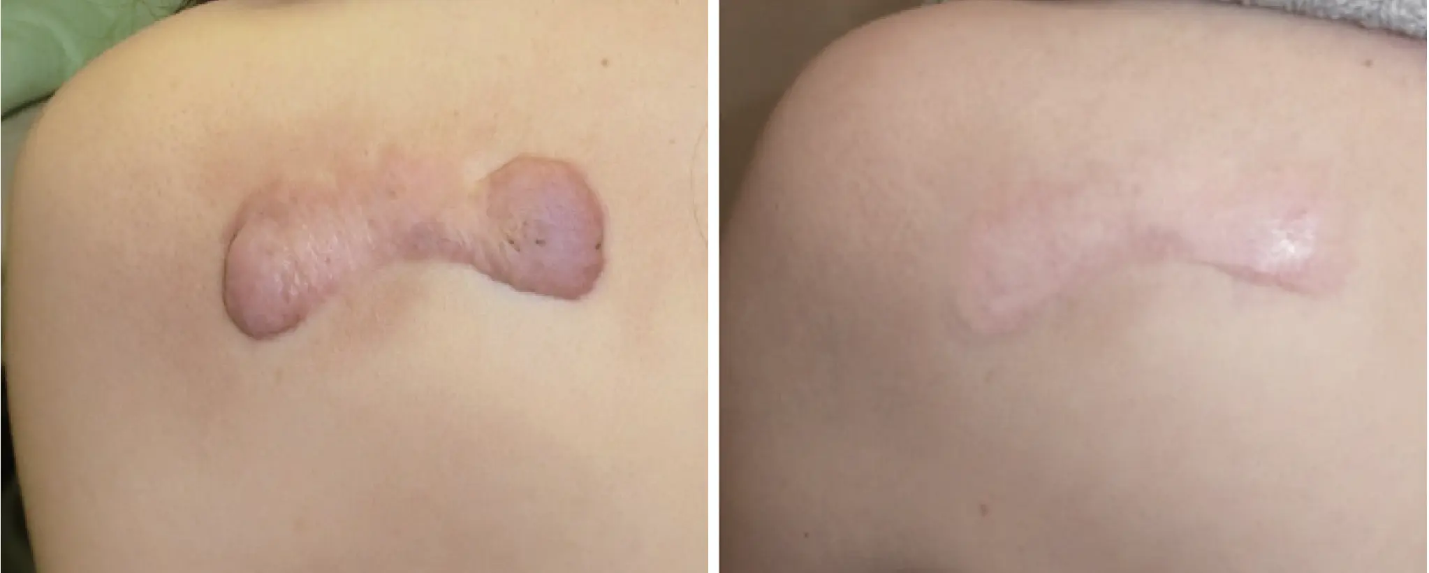 Before and after images of an extensive back keloid scar that becomes flatter and lighter after treatment.